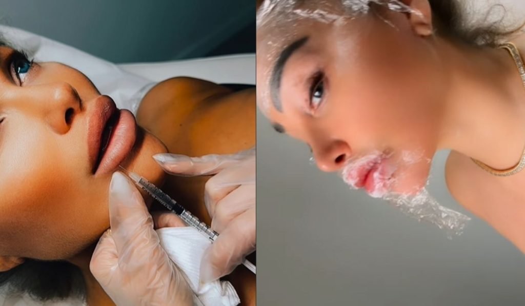 The twins' lip filler dissolving documented on Instagram